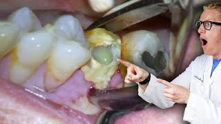 Badly Infected Tooth Extraction Procedure With Pus Coming Out of The Tooth [upl. by Teerprah]