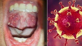 Coxsackie Virus Incubation Period Symptoms Treatment amp Rash [upl. by Alfeus]