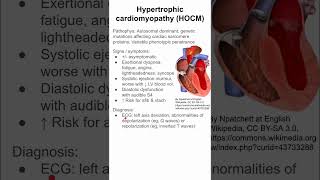 Hypertrophic cardiomyopathy HOCM [upl. by Nimrahc]