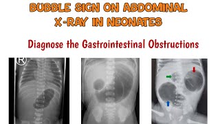 Signs in intestinal obstruction  Bubble signs on Abdominal xray  intestinal obstruction [upl. by Eberhart]