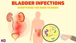 Bladder Infections The Silent Epidemic Affecting Millions of Women [upl. by Ecidnac]