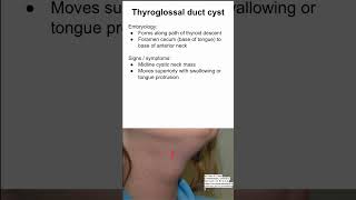 Thyroglossal duct cyst [upl. by Abijah184]