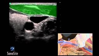 How To Ultrasound Guided Insertion Internal Jugular Catheter Long 3D Video [upl. by Deeas195]