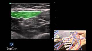 How To Ultrasound Guided Saphenous Nerve Block 3D Video [upl. by Dunkin]