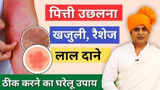 पित्ती उछलना खजुली रैशेज लाल दाने ठीक करने का घरेलू उपाय  Sanyasi Ayurveda [upl. by Dhiren714]