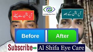 Ptosis Droopy Eyelids Treatment  Jhuki rehne wali palkon ka ilaj in Pakistan [upl. by Pyle]