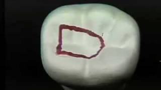 Endodontic Cavity Preparation  Phase I  Posterior [upl. by Elatnahc577]