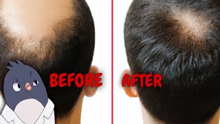 Saw Palmetto Natures Solution for Hair Loss Research Comparing to the Medication Finasteride [upl. by Osnola]