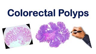 Colorectal Polyps USMLE STEP NCLEX COMLEX [upl. by Neras771]