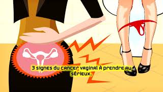 3 signes du cancer vaginal à prendre au sérieux [upl. by Aicre]