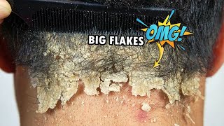 Psoriasis Scalp Scratching Big Flakes 610 [upl. by Nothsa]