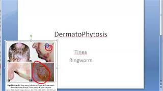 Microbiology 573 a DermatoPhytosis RingWorm Trichophyton Microsporum Epidermophyton ID reaction [upl. by Ahsiym]