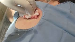 Abscess Opening and Drainage [upl. by Akehsal700]