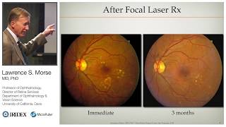 Management of Diabetic Macular Edema with MicroPulse Laser Therapy [upl. by Leugimesoj]