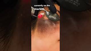 THIS Laser Can Erase Birthmarks Birthmark TreatmentHyperpigmentation laserskincare [upl. by Rexanna]