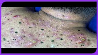 Satisfying Blackheads Removal Popping Pimples and Blackheads on Skin  2024 [upl. by Teresita]