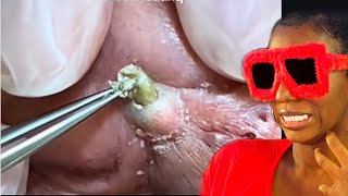 Best of Blackheads  Dilated Pore Of Winer  reaction [upl. by Xenos]