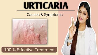 Urticaria treatment  Hives causes symptoms prevention and treatment [upl. by Mongeau]