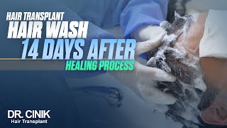 DrCinik Hair Transplant  14 Days Hair Wash After Healing Process [upl. by Pearman]