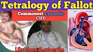 Tetralogy of Fallot  TOF  Commonest Cyanotic CHD  TET Spell  Cyanotic Spells [upl. by Tesil]