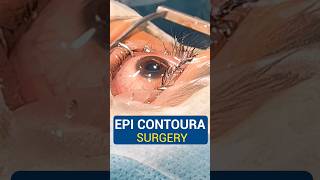 Live EPI Contoura Surgery [upl. by Notanhoj12]