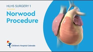 What is the Norwood Procedure for Hypoplastic Left Heart Syndrome [upl. by Ahsaekal237]