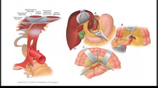 Grand Rounds with Dr Gustavo Oderich quotMesenteric Arterial Disease Current Therapyquot [upl. by Besnard]