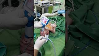 Newborn intubation using UE Miller 0 blade [upl. by Enair]