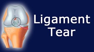 Ligament Tear [upl. by Buchalter]