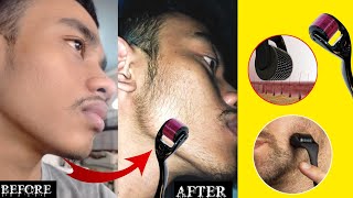 Derma roller for beard  minoxidil beard  derma roller beard growth man matters beard oil review [upl. by Siddra]