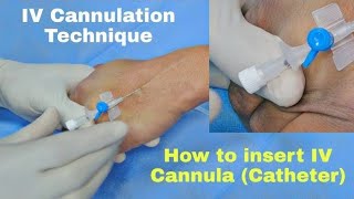 Intravenous cannula insertion techniques How to insert IV Cannula [upl. by Terrel]