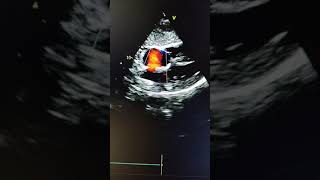 Ostium Secundum OS  ASD in subcostal view in echocardiography [upl. by Jelena]