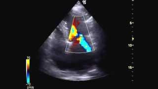 Echocardiography mitral valve stenosis ultrasound [upl. by Girard]