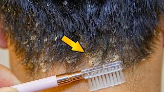 Dandruff Treatment At Home Big Flakes Dandruff Removal [upl. by Olwen]