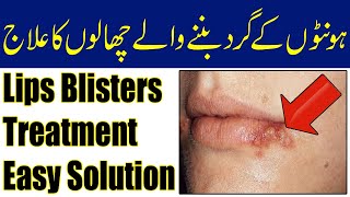 Honton K Chalon Ka Ilaj  Blisters Around Lips Causes [upl. by Ibmab787]