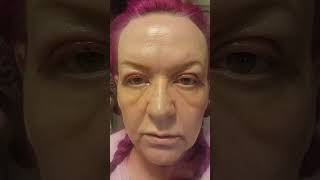 TRIGGER WARNING ⚠️ upper blepharoplasty surgery [upl. by Hirz441]