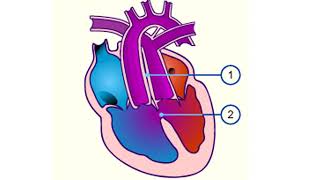 CARDIOPATHIE CONGENITALE ET INSUFFISANCE CARDIAQUE CHEZ LENFANT [upl. by Olaf]