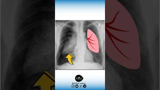 🔻 Anatomie VS Radiologie Part 2 un pneumothorax [upl. by Marie]