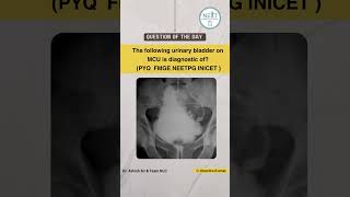 Options  A TB Bladder B Neurogenic bladder C Bladder diverticula D Bladder outlet obstruction [upl. by Emerson]