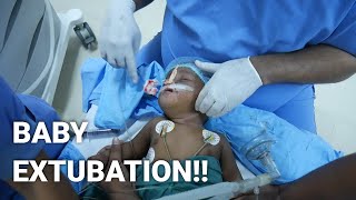 Paediatric Anaesthetics  Extubation of Child after cleft lip surgery [upl. by Ater]