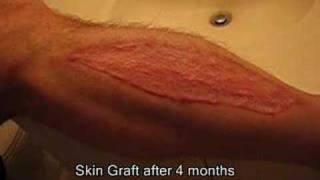 Part 4  Brads Surgery 4 months after graftb [upl. by Walczak]