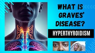 What You Need to Know About Graves Disease thyroiddisorders hyperthyroidism gravesdisease [upl. by Eiroj632]