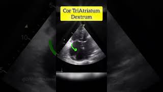 Cor Triatriatum Dextrum echocardiography cardiology Echocardiography test [upl. by Benildas348]