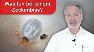 Zeckenbiss  was tun Impfung gegen Borreliose und FSME [upl. by Devaney]