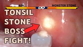 IMPACTED MONSTER TONSIL STONE REMOVAL  AIM 9 [upl. by Ahsitniuq274]