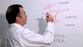 Los efectos de la retinopatía diabética sobre el ojo  Módulo 2  Dr Castro Salas [upl. by Tipton]