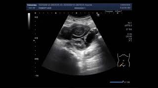 Ultrasound Video showing Multiseptic Ovarian Cyst [upl. by Pavia]