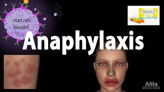 Anaphylaxis Animation [upl. by Eey492]