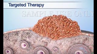 Treatment Options for Ovarian Cancer [upl. by Nairb]