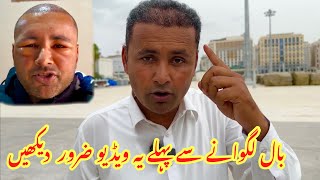 Must Watch Before Hair Transplant  Hair Transplant Complete Process and Final Results  Mubashir [upl. by Teodora]